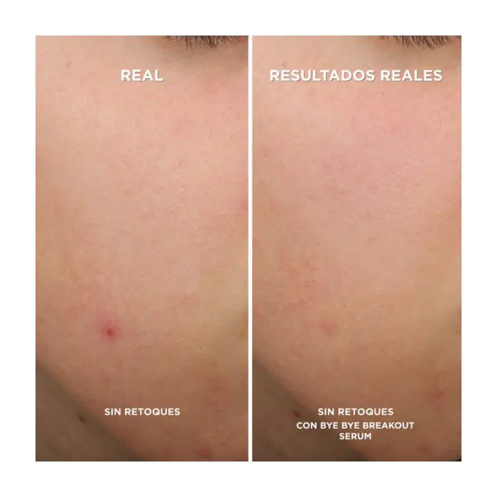 Bye Bye Breakout Serum