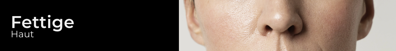 Acne
