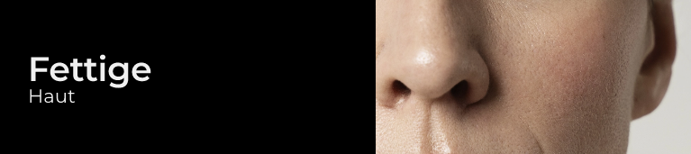 Acne