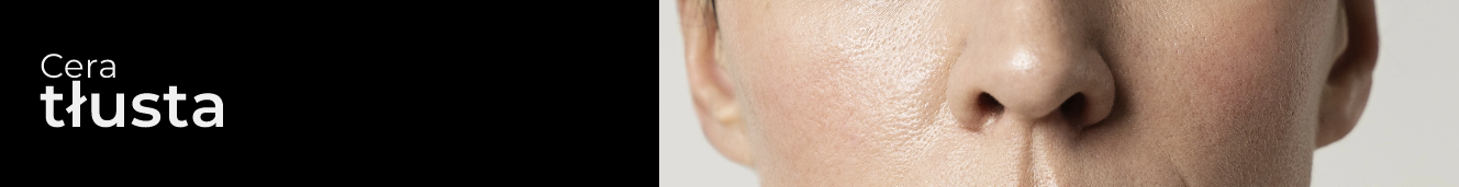Acne